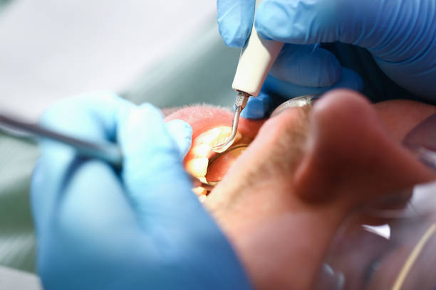Best Emergency Wisdom Tooth Extraction in Sutter, CA